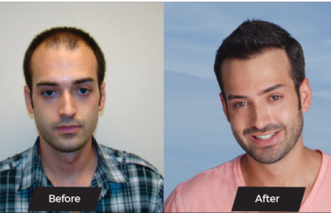 Great Hair Transplants